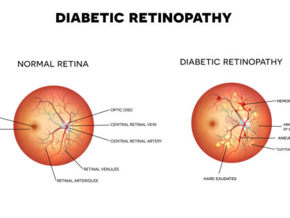 Czym jest retinopatia cukrzycowa i jak się objawia?