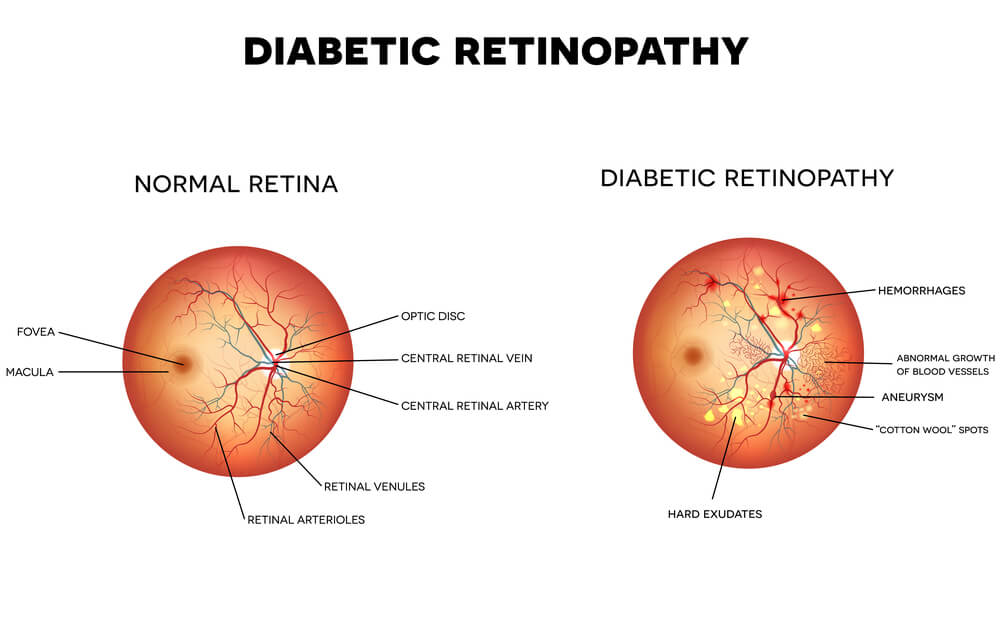 retinopatia-cukrzycowa